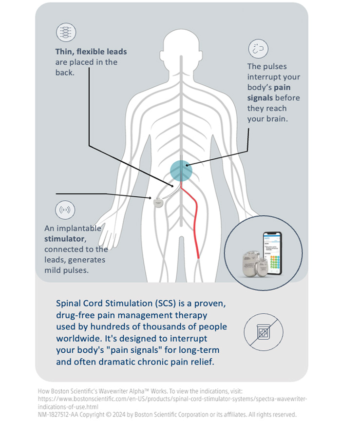 Spinal Cord Stimulator in Ventura